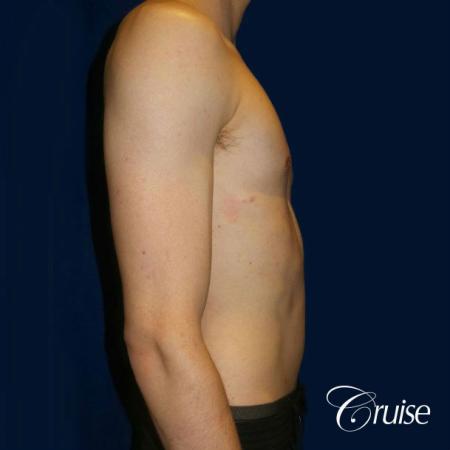 Top Gynecomastia Specialist Dr. Cruise - After Image 4
