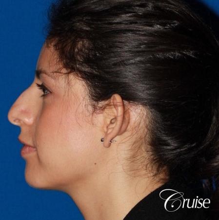 best otoplasty with natural appearance on female - Before Image 2