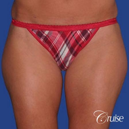 best thigh thinning liposuction on thighs - Before and After Image 2