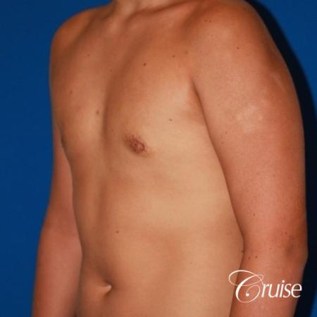 severe puffy nipple on teenager - After Image 3