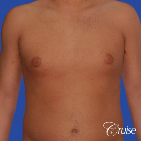 best puffy nipple gynecomastia results with plastic surgeon, Joseph Cruise, M.D. - Before Image 1
