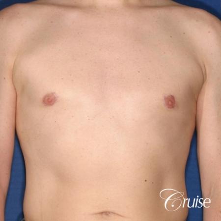 moderate gynecomastia on adult donut lift - After Image 1