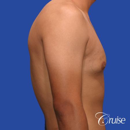 mild gynecomastia standard PA areola incision - Before and After Image 4