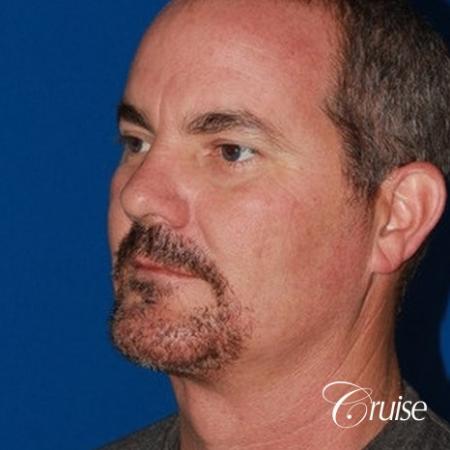 best pictures of chin augmentation with specialist - After Image 3