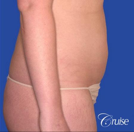 best skinny abs from liposuction abdomen and flanks - Before and After Image 4