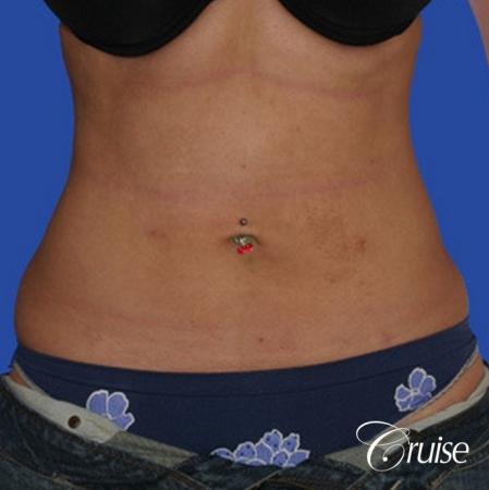 top plastic surgeon for liposuction in Newport Beach - After Image