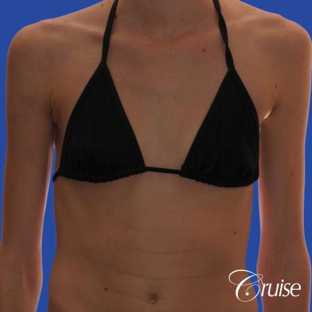 Breast Augmentation - Before and After Image 4