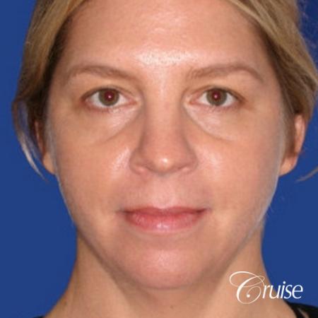 female who got large chin implant in Newport Beach - Before Image 1
