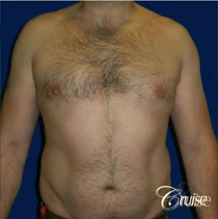 male breast reduction surgery - After Image 1