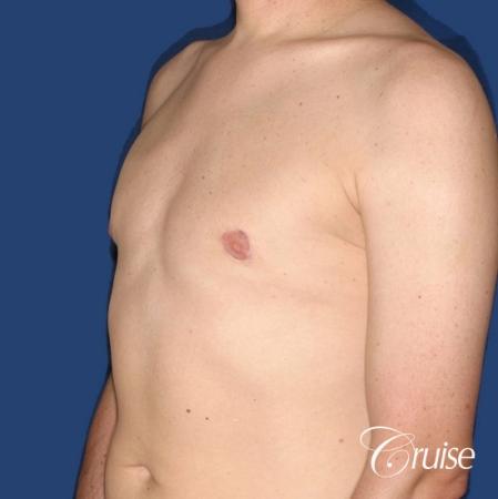 moderate gynecomastia on adult donut lift - After Image 3