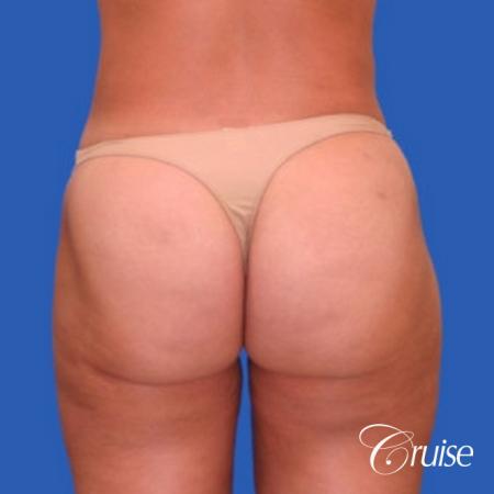 best liposuction abdomen flanks medial and lateral thighs dramatic - After Image 3