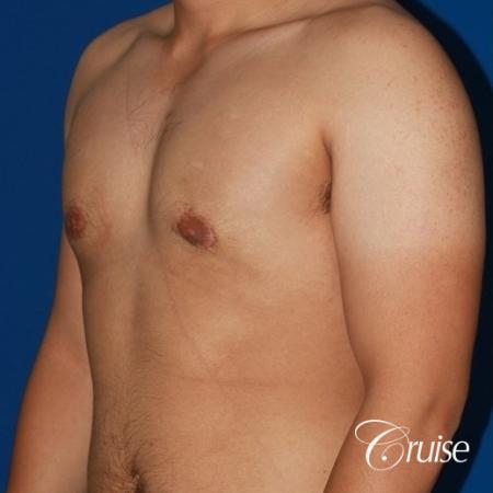 puffy nipple male breast on young adult - After Image 3