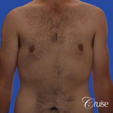 weight loss patient with gynecomastia - After Image 1