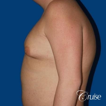 moderate gynecomastia with free nipple graft scar on teenager - Before Image 3