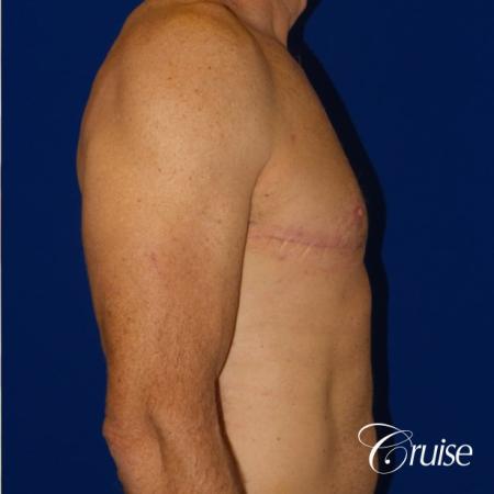 Top Gynecomastia surgeons - After Image 4