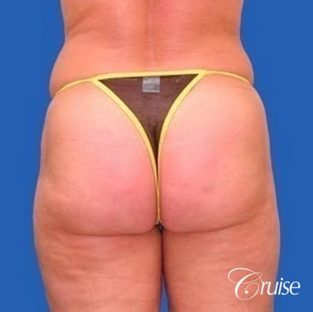 best liposuction abdomen, flanks and thighs - After Image 3