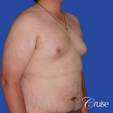 weight loss patient with gynecomastia - Before and After Image 3