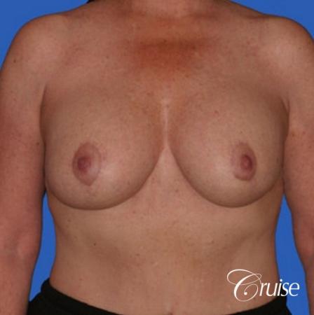best breast lift anchor with saline augmentation - After Image 1
