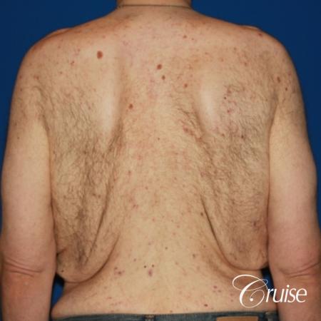 severe weight loss gynecomastia upper body lift - Before Image 4