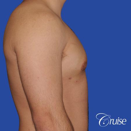mild case of gynecomastia on adult - After Image 3