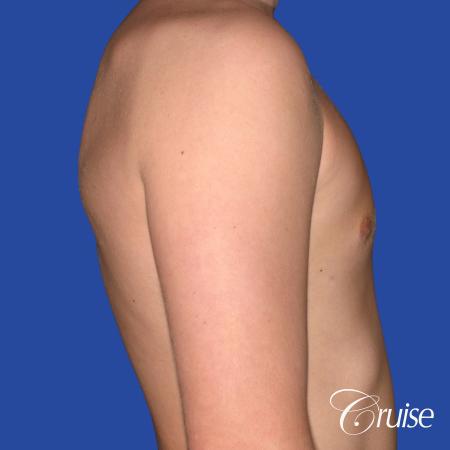 teen with pointy / puffy nipples get gynecomastia surgery - After Image 3