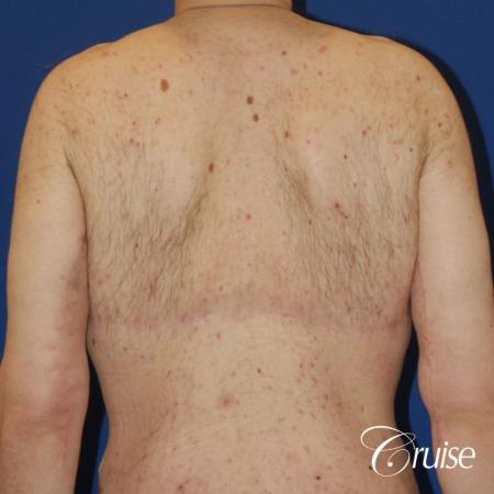severe weight loss gynecomastia upper body lift - 1 After Image 4