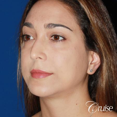 best medium chin implant on young patient - After Image 3