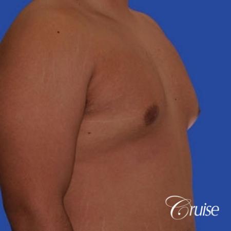 mild gyne on 24yr old adult - Before and After Image 4