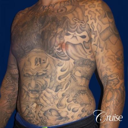 Moderate Gynecomastia Areola Incision - Before and After Image 3