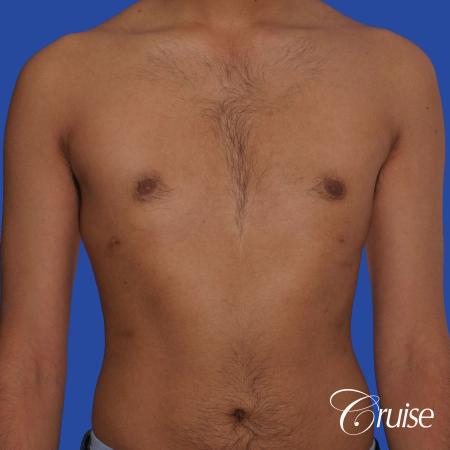 best before and after results for gynecomastia surgery - After 1