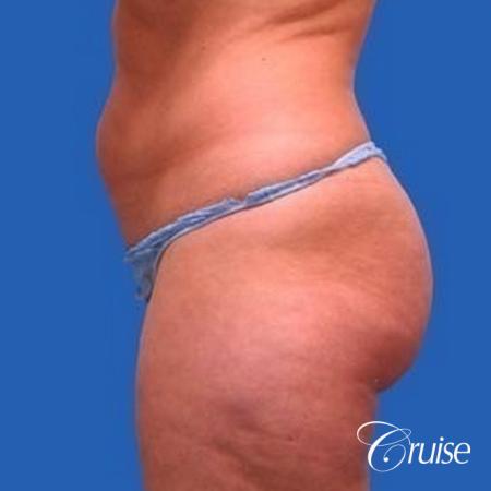 best liposuction abdomen, flanks and thighs - Before Image 2