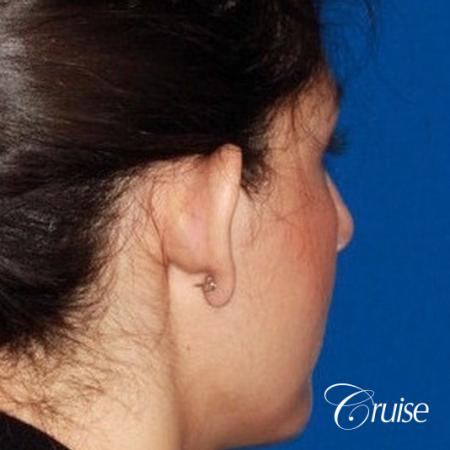 best otoplasty with natural appearance on female - Before Image 3