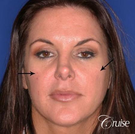 Fat Transfer - Temple, Tear Trough, Lower Lids, Cheeks - Before Image