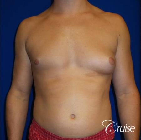 Unilateral gynecomastia - Before Image 1