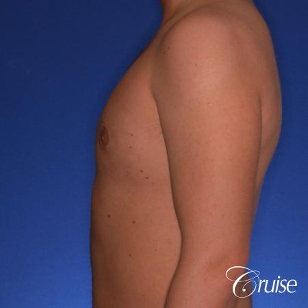 best puffy nipple gynecomastia results with plastic surgeon, Joseph Cruise, M.D. - After Image 2