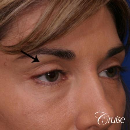 best soft tissue filler using Juvaderm - Before Image 3