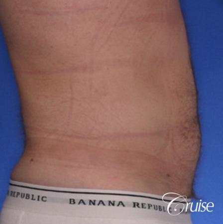 male muffin top liposuction pictures - After Image 2