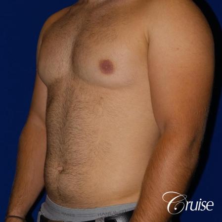 best gynecomastia results - Before Image 2