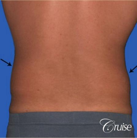best liposuction to contour a males body - Before and After Image 3