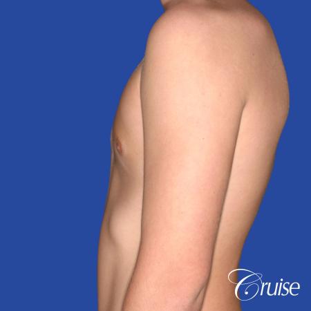 teen with pointy / puffy nipples get gynecomastia surgery - After Image 2