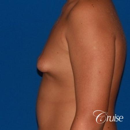 severe puffy nipple on teenager - Before Image 2