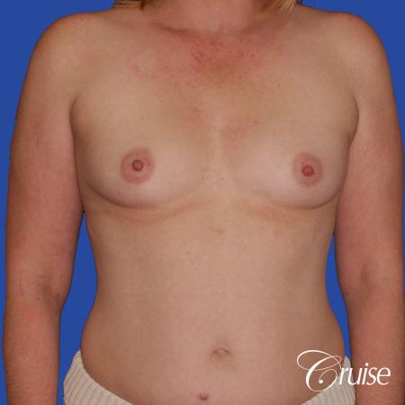 Breast Augmentation - Before Image 1