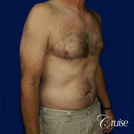Moderate Gynecomastia Pedicle - After Image 4