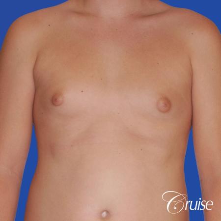 teen with pointy / puffy nipples get gynecomastia surgery - Before Image 1