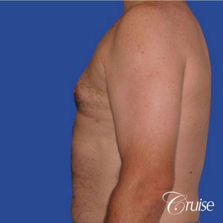 chest liposuction on adult - After Image 2