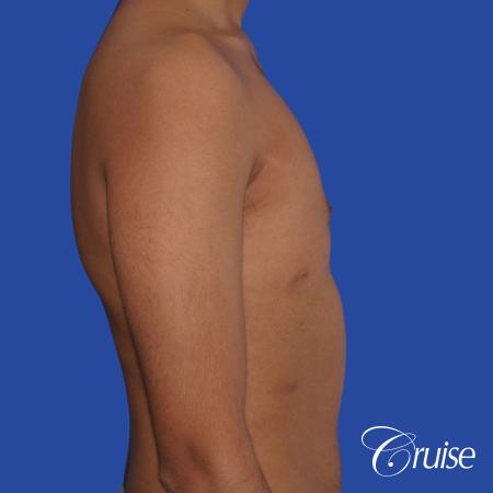 best before and after results for gynecomastia surgery - After 3