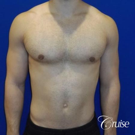 gynecomastia correction newport beach - After 1