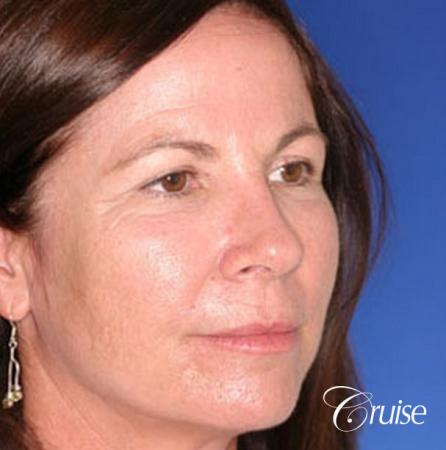 best plastic surgery on upper eyelids - Before Image 3
