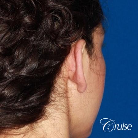 best otoplasty with natural appearance on female - After Image 3