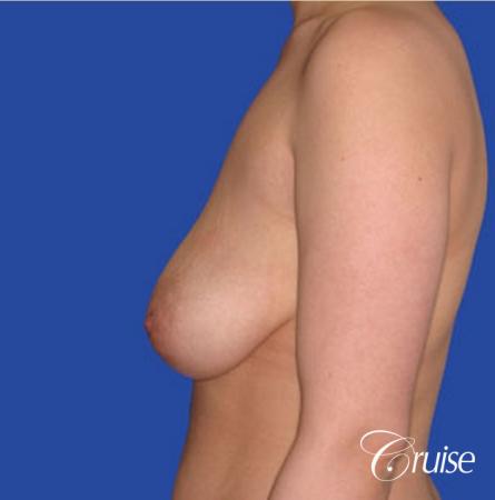 best round saline implants after breast reduction - Before Image 2